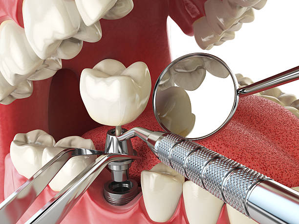 Best Dental Abscess Treatment in Dover, FL